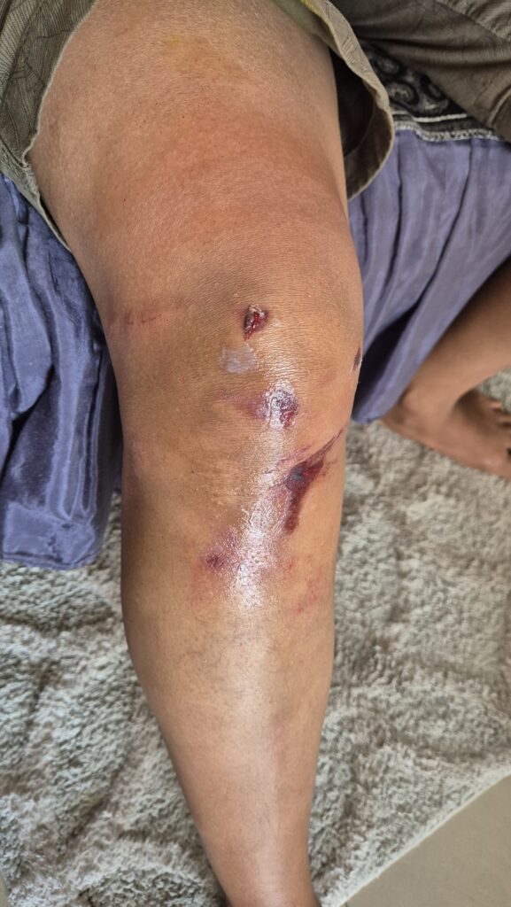 preeti damage after accident on 26th may 25