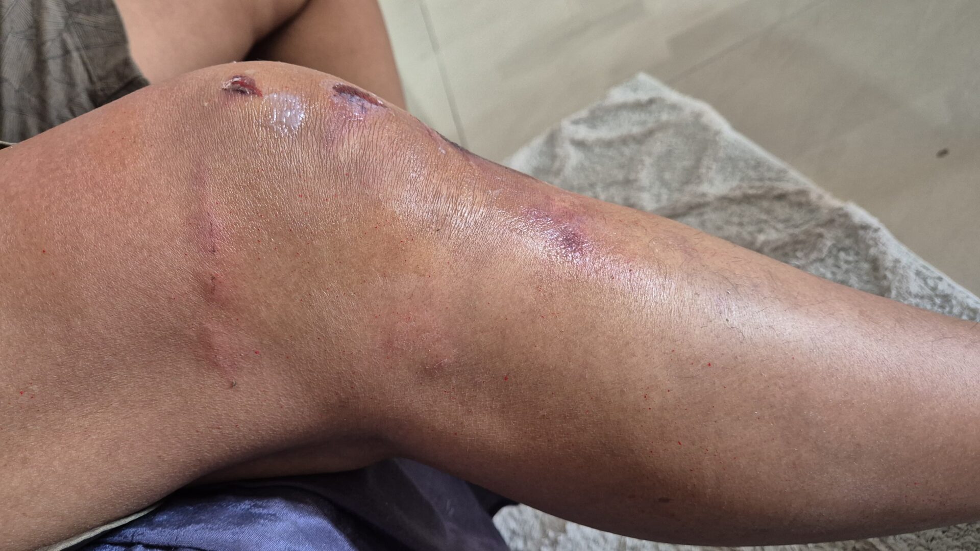 fracture on knee of wife preeti leg