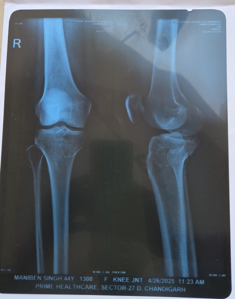 xray of preeti on 26th april 25 when we visited dr aseem goyal